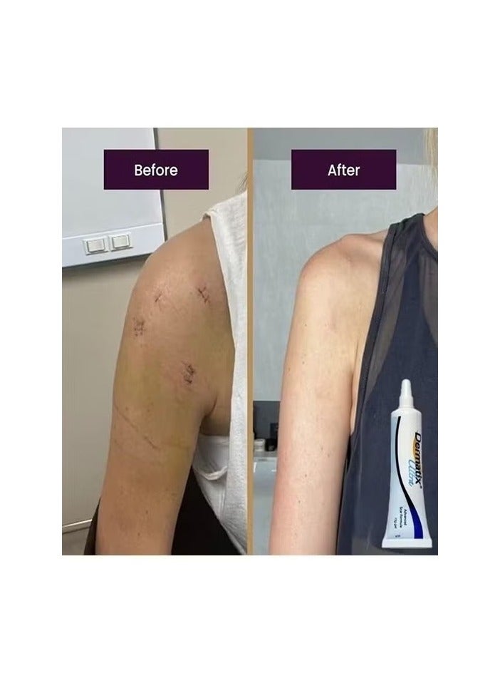 ديرماتيكس جل ديرماتيكس المتطور لعلاج الندبات 15 غرام لتحسين مظهر الندبات، سريع الجفاف، بتركيبة فريدة من جل السيليكون، يُستخدم لعلاج الندبات الجدرية والجراحية والضخامية، مناسب للبشرة الحساسة - Image 3